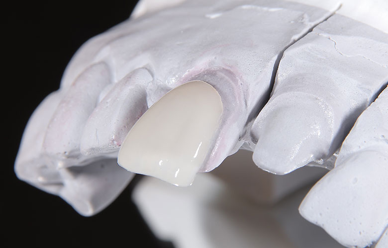 東京神楽坂歯科　審美治療