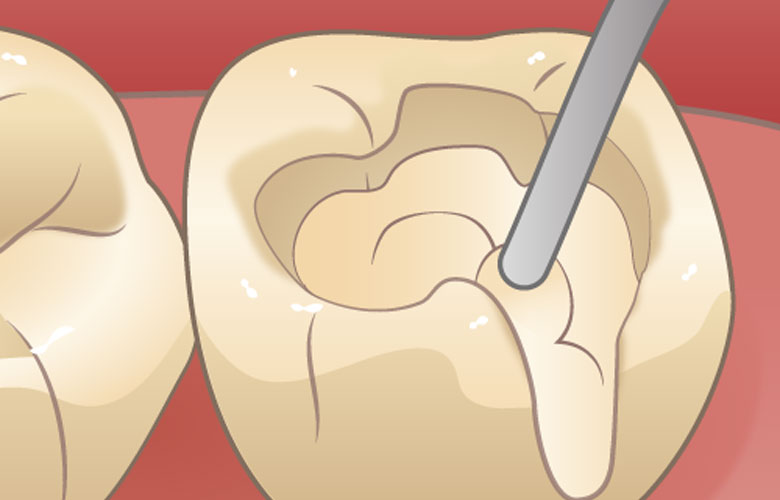 東京神楽坂歯科　一般歯科・虫歯治療