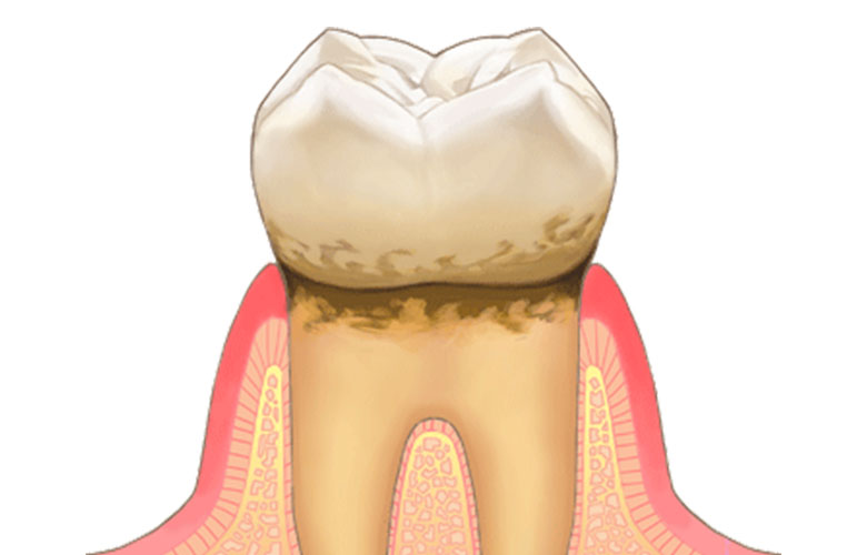 東京神楽坂歯科　歯周病治療