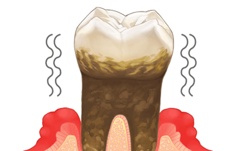 東京神楽坂歯科　歯周病治療