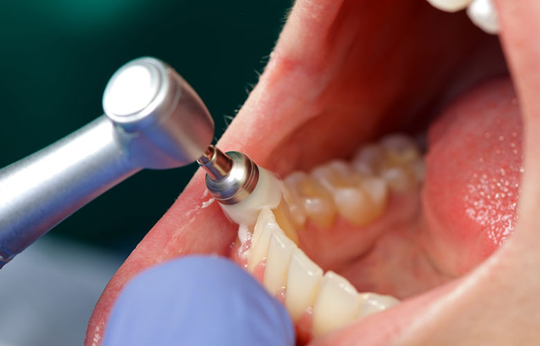 東京神楽坂歯科　予防歯科・PMTC