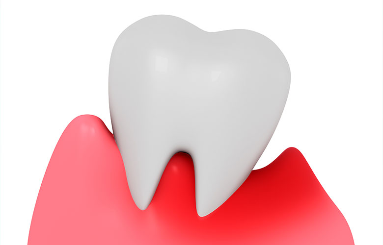 東京神楽坂歯科　歯茎の再生治療