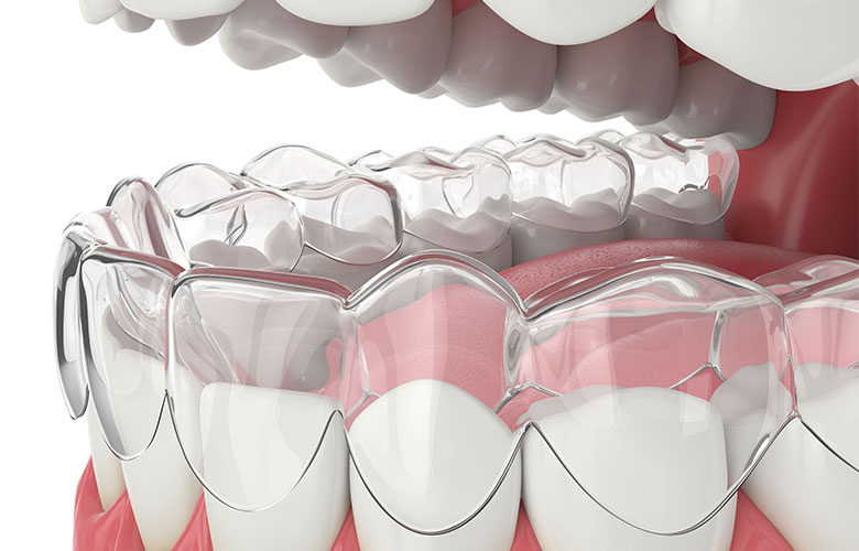 東京神楽坂歯科　歯茎の再生治療