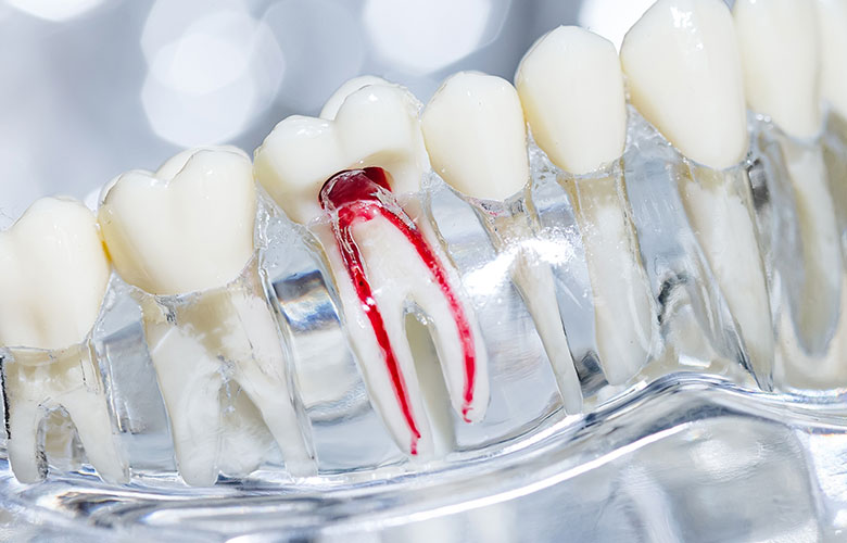 東京神楽坂歯科　根管治療