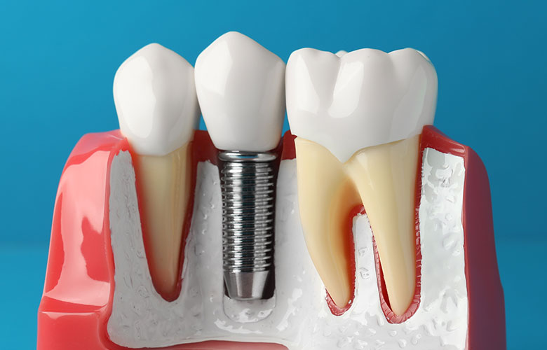 東京神楽坂歯科　自家歯牙移植