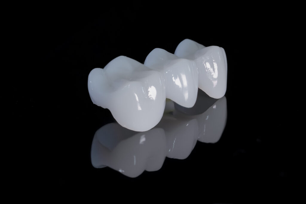 Cercon porcelain tooth bridge