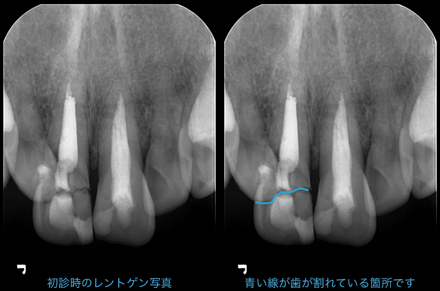 初診時のレントゲン写真