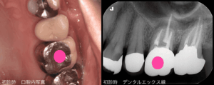 初診時の口腔内写真とデンタルエックス線
