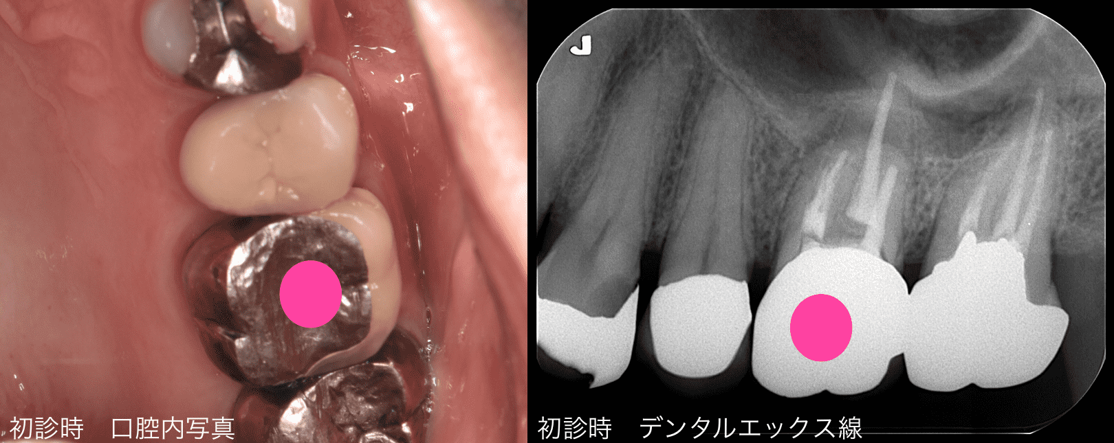 初診時の口腔内写真とデンタルエックス線