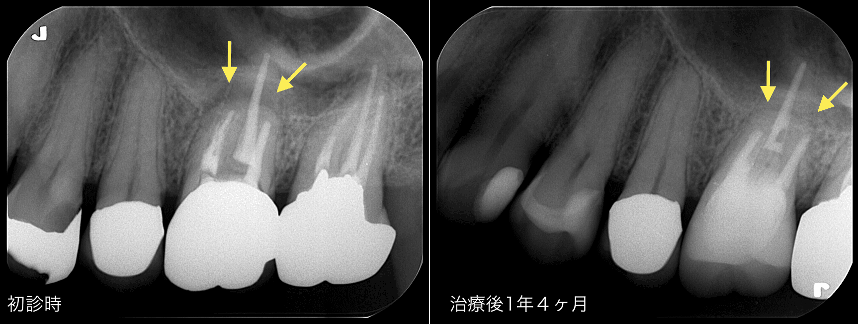 初診時と治療後1年4カ月のレントゲン写真