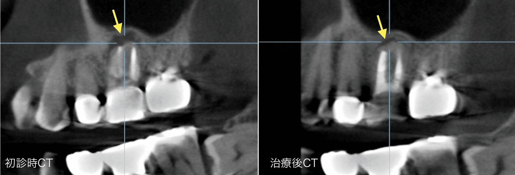 初診時CTと治療後CT