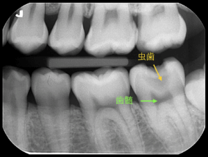 虫歯と歯髄