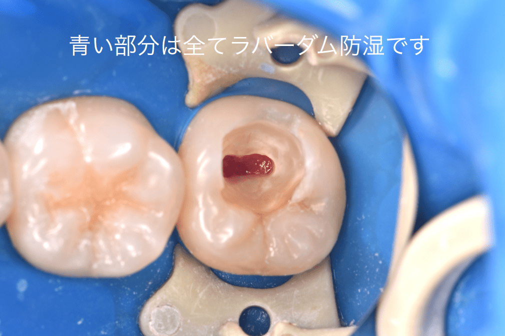 ラバーダム防湿による感染管理