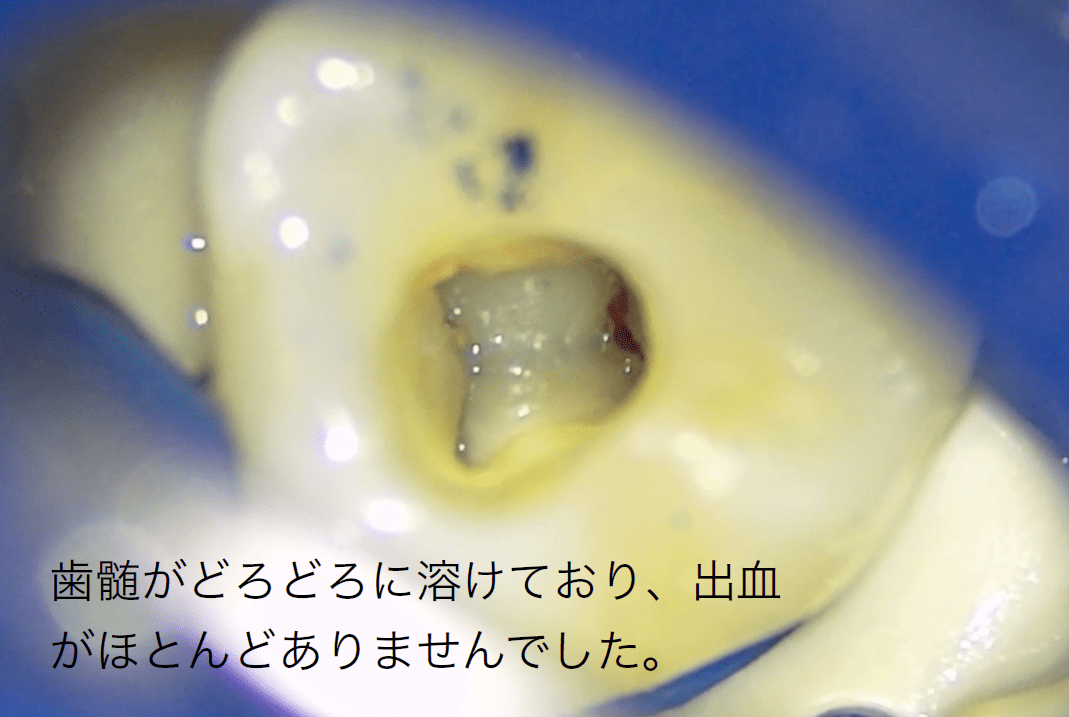 歯髄の感染や炎症が進行している場合