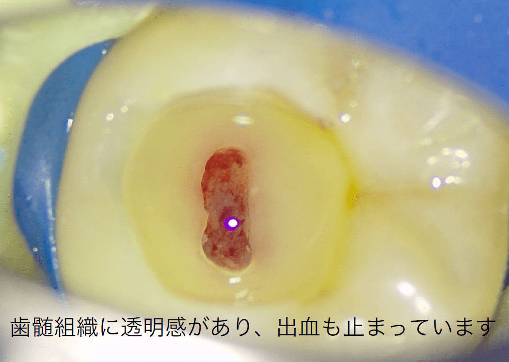 虫歯の除去中に歯髄が露出した場合