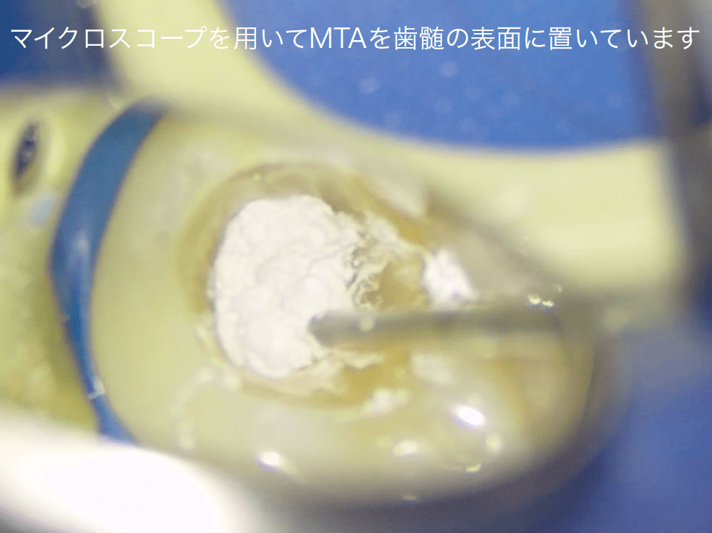 MTAを用いた適切な歯髄保護および経過観察