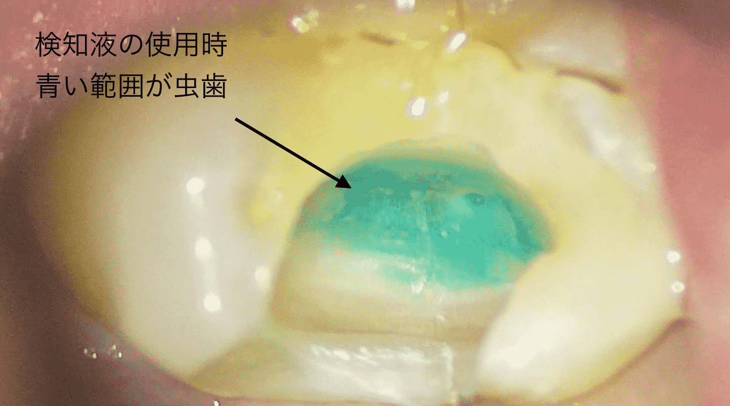 う蝕検知液を補助的に使用した様子