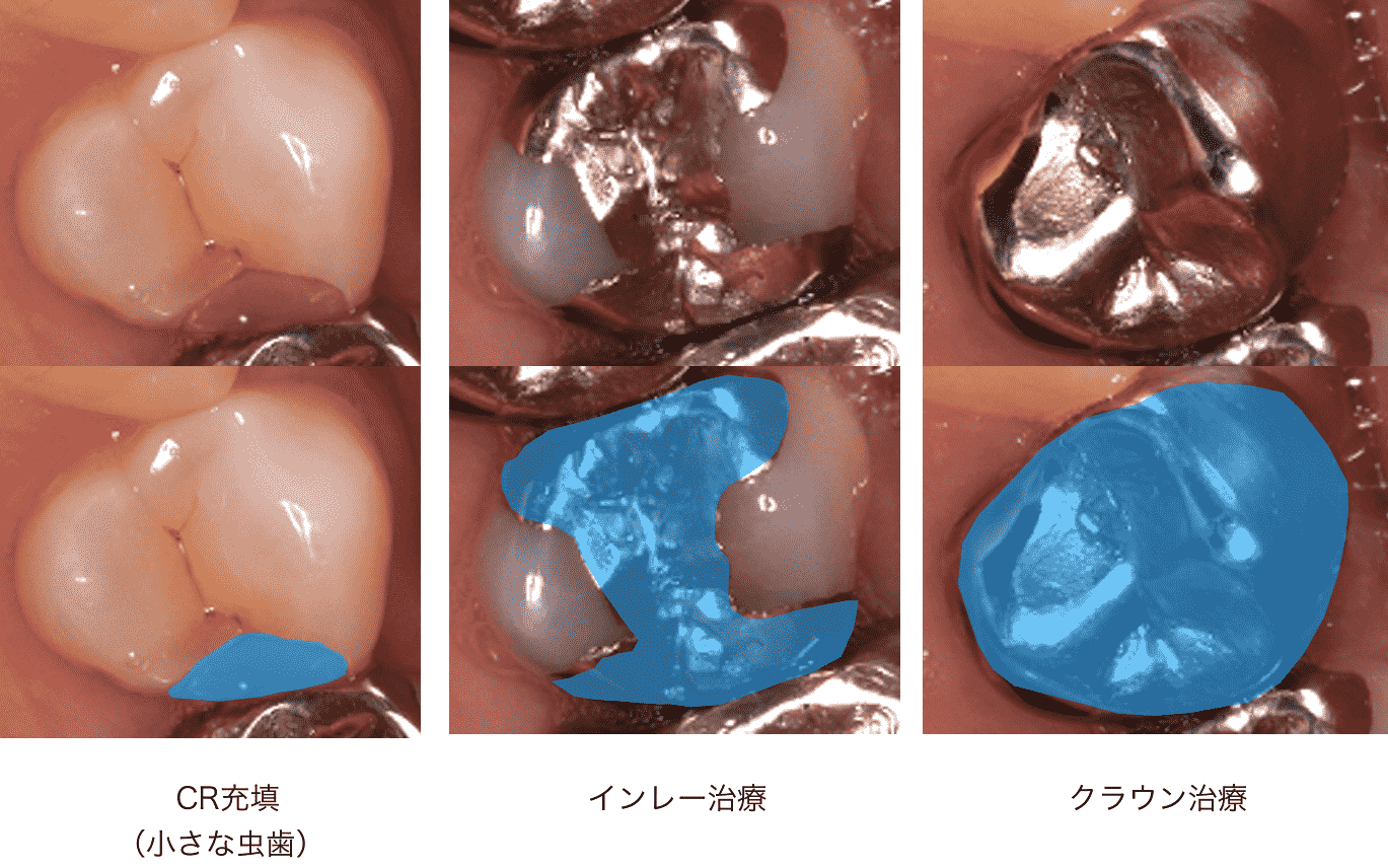 虫歯治療と歯を削る範囲の比較